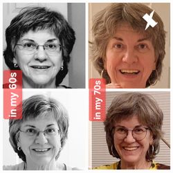 Richard Cunningham, DDS - Left side shows the old implants. Right side shows the temporary prosthetic, after my surgeries.
