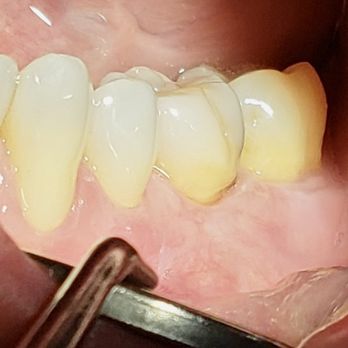 John U Choi, DDS, PhD - (Case 13). Connective tissue graft (4). Complete reconstruction of severe root abrasion in one surgery. - Periodontists Near Me - Fullerton, California John U Choi, DDS, PhD - (Case 13). Connective tissue graft (4). Complete reconstruction of severe root abrasion in one surgery. - Periodontists Near Me - Fullerton, California