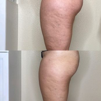 Inscape Body Aesthetics - 5 Anti-Cellulite treatments
Top photo is before bottom photo is after - Body Contouring Near Me - Benicia, California Inscape Body Aesthetics - 5 Anti-Cellulite treatments
Top photo is before bottom photo is after - Body Contouring Near Me - Benicia, California