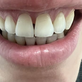 Ferris Orthodontics - Orthodontist in Leon Springs, TX - After my treatment - Orthodontists Near Me - San Antonio, Texas Ferris Orthodontics - Orthodontist in Leon Springs, TX - After my treatment - Orthodontists Near Me - San Antonio, Texas