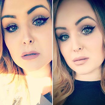 DermFx - Before and less than 24 hours after. 1 full syringe of Juvederm Ultra - Medical Spas Near Me - Newport Beach, California DermFx - Before and less than 24 hours after. 1 full syringe of Juvederm Ultra - Medical Spas Near Me - Newport Beach, California