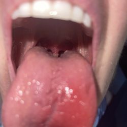Your Healthcare - Just pus in my throat