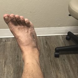 Foot & Ankle of Indio - Bone spur removal. All went good.