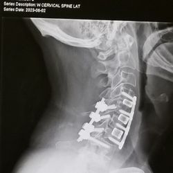 SCL Health - Post-surgical hardware