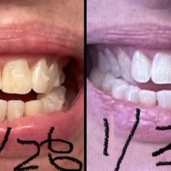 Legacy Hill Dentistry - Wow just WOW - 29 days - my jaw is moving so fast - day 1 on the right!
