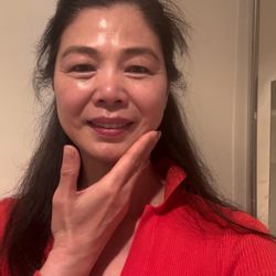 My Skin after five days of green peel