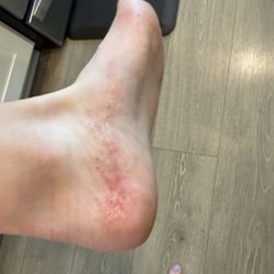 Aurora Nail Bar - Rash from pedicure