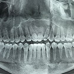 Ron An Vuong, DDS, MD - X-ray of wisdom teeth