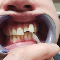 Reza Kasiri, DDS - Emergency Dentist - A fracture tooth before fixing it
