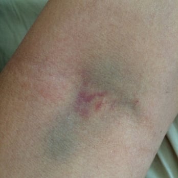 Quest Diagnostics - Two days later after getting bloodwork done - Laboratory Testing Near Me - Fullerton, California