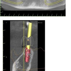 La Jolla Dental Implants & Periodontics - Guided surgery