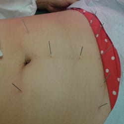 Yang's Acupuncture and Herbs - Acupuncture therapy
