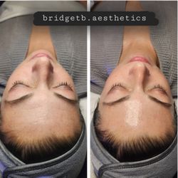 Concierge Aesthetics and Plastic Surgery - Before and after a hydro facial