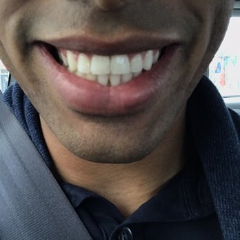 Yang Orthodontics - After treatment. Love my new smile! - Orthodontists Near Me - Redwood City, California Yang Orthodontics - After treatment. Love my new smile! - Orthodontists Near Me - Redwood City, California