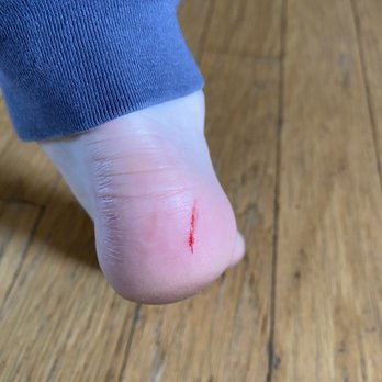 Floor Magic - a red spot on the foot of a child - Flooring Near Me - Rockport, Maine Floor Magic - a red spot on the foot of a child - Flooring Near Me - Rockport, Maine