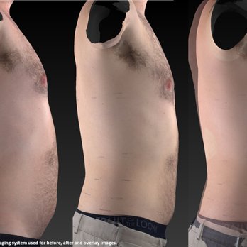 Bend Laser Lipo - Before and After results for 12 treatments - Plastic Surgeons Near Me - Bend, Oregon