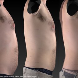 Bend Laser Lipo - Before and After results for 12 treatments
