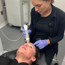 Lazaderm - Microneedling