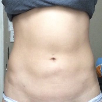 MyShape Lipo - Medical Spas Near Me - Henderson, Nevada