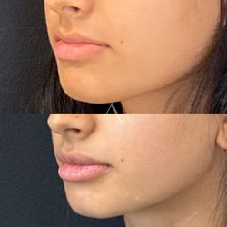 Aesthetx - Lip filler