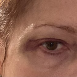 Midway Med Spa - Midway Medspa caused massive bruising after Botox for Crow's feet - 2 days after injections.