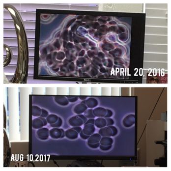 Rooted Wellness - My father's wet blood sample from 2016-2017. - Nutritionists Near Me - Santa Ana, California Rooted Wellness - My father's wet blood sample from 2016-2017. - Nutritionists Near Me - Santa Ana, California