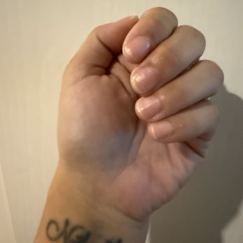 Houston Methodist Primary Care Group - 2 weeks post treatment. Nails have thinned and are returning to normal color. - Family Practice Near Me - Richmond, Texas Houston Methodist Primary Care Group - 2 weeks post treatment. Nails have thinned and are returning to normal color. - Family Practice Near Me - Richmond, Texas