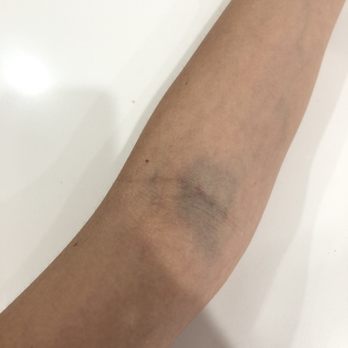 Quest Diagnostics - Severely bruised and left with swelling and pain 4 hours after blood draw. - Laboratory Testing Near Me - Beverly Hills, California