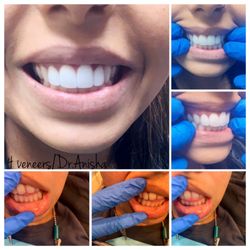 Anisha Nguyen, DDS - Mile Square Park Family Dental Group - Before n after