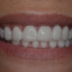 Vance Dentistry - Cosmetic Patient Vance Dentistry