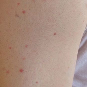 Skinlastiq - This happened  the next day after the treatment, and they refused  to take responsibility of their mistake - Skin Care Near Me - Burlingame, California