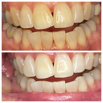 Smile Spark - Teeth Whitening Near Me - Henderson, Nevada