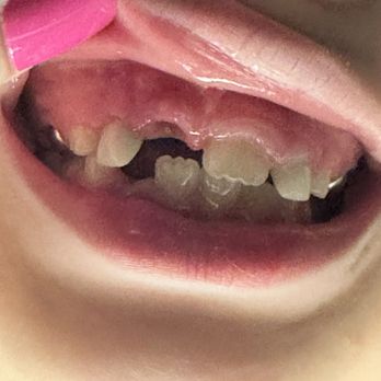 Seneca Mariano, DDS - After - General Dentistry Near Me - Newark, California Seneca Mariano, DDS - After - General Dentistry Near Me - Newark, California