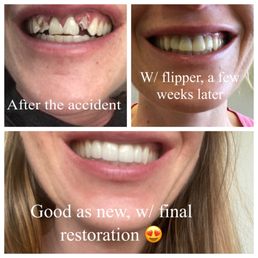 So happy with the final restoration and my entire experience with Dr. Geller and team So happy with the final restoration and my entire experience with Dr. Geller and team