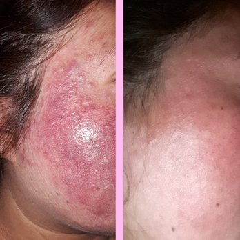 Clinically Clear - Dramatic reduction of inflammation and breakouts in just a few weeks. Work in progress. - Acne Treatment Near Me - San Leandro, California