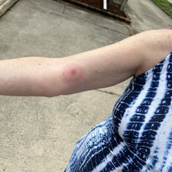 ProMedica Urgent Care - Perrysburg - Brown recluse bite