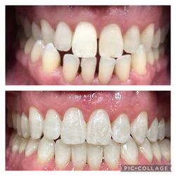 ZenDental - Alessandra Raschkovsky, DDS - Invisalign before and after