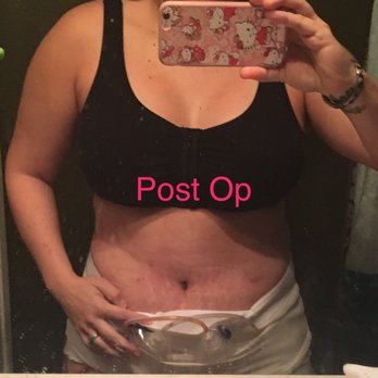 Precision Plastic Surgery - This is Post Op I was in tears because I could not believe how good I looked right after my surgery! THANK YOU DR. KU - Cosmetic Surgeons Near Me - Rancho Cucamonga, California