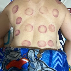 Superior Healing Wellness - Result from my cupping