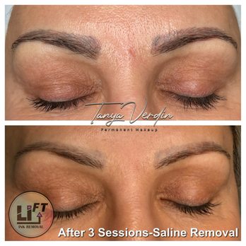Lush Brow Artistry - Saline Tattoo Removal after 3 sessions (number of sessions required varies per case) - Permanent Makeup Near Me - Park Ridge, Illinois Lush Brow Artistry - Saline Tattoo Removal after 3 sessions (number of sessions required varies per case) - Permanent Makeup Near Me - Park Ridge, Illinois