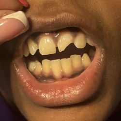 Plaza Midwood Dentistry - Before and after