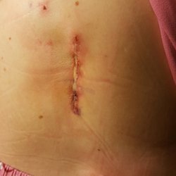 Barrow Brain and Spine - Chandler - Infected ncision-1 week after surgery.  Treated, but not seen again for 3 weeks, at which time it was severely infected.
