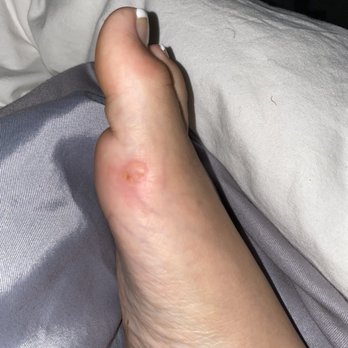 Modo Nail Bar - Injury suffered after over scrapping my foot with a tool. - Skin Care Near Me - Laurel, Maryland