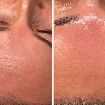 Dolce Aesthetics - Facial massages can help reduce forehead wrinkles by improving blood circulation, relaxing facial muscles, and promoting collagen production - Eyebrow Services Near Me - Beverly Hills, California Dolce Aesthetics - Facial massages can help reduce forehead wrinkles by improving blood circulation, relaxing facial muscles, and promoting collagen production - Eyebrow Services Near Me - Beverly Hills, California