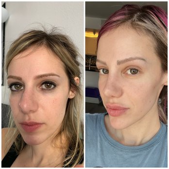 Roger Tsai, MD - Before and after - 4 months post op - Cosmetic Surgeons Near Me - West Hollywood, California Roger Tsai, MD - Before and after - 4 months post op - Cosmetic Surgeons Near Me - West Hollywood, California