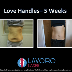 Lavoro Laser - Joy had her abdominals laser-ed and achieved a complete loss of the fat layer without any loose skin in only 5 weeks and 15 sessions.