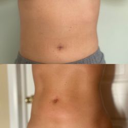 Chelsea Likes Your Face - Results after 2 cavitation treatments