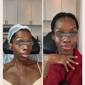 Dashacosmetology - 60 units Botox - Skin Care Near Me - New York, New York Dashacosmetology - 60 units Botox - Skin Care Near Me - New York, New York