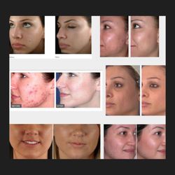 Skinovation - Before & Afters... Acne, Hyperpigmentation, Fine Lines and wrinkles , scaring.
