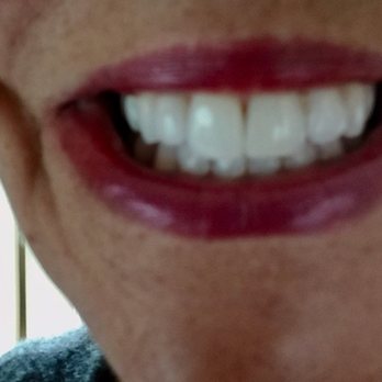 Brian M Baliwas, DDS - Dr. Baliwas rebonded a decades' old, yellowing chip repair and gave me back a perfect front tooth! - General Dentistry Near Me - San Francisco, California